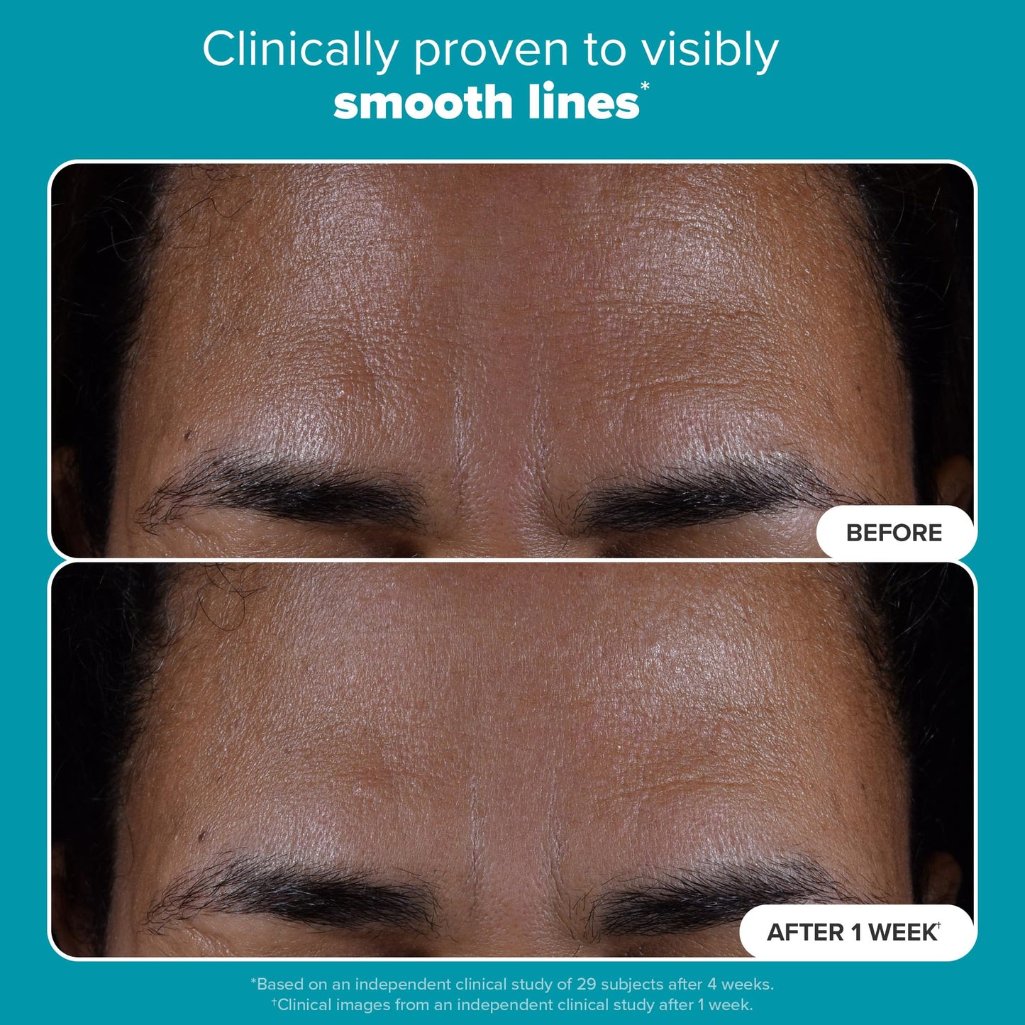 Paula's Choice SKIN PERFECTING 2% BHA Liquid Salicylic Acid Exfoliant - Blackheads & Pores, 4oz