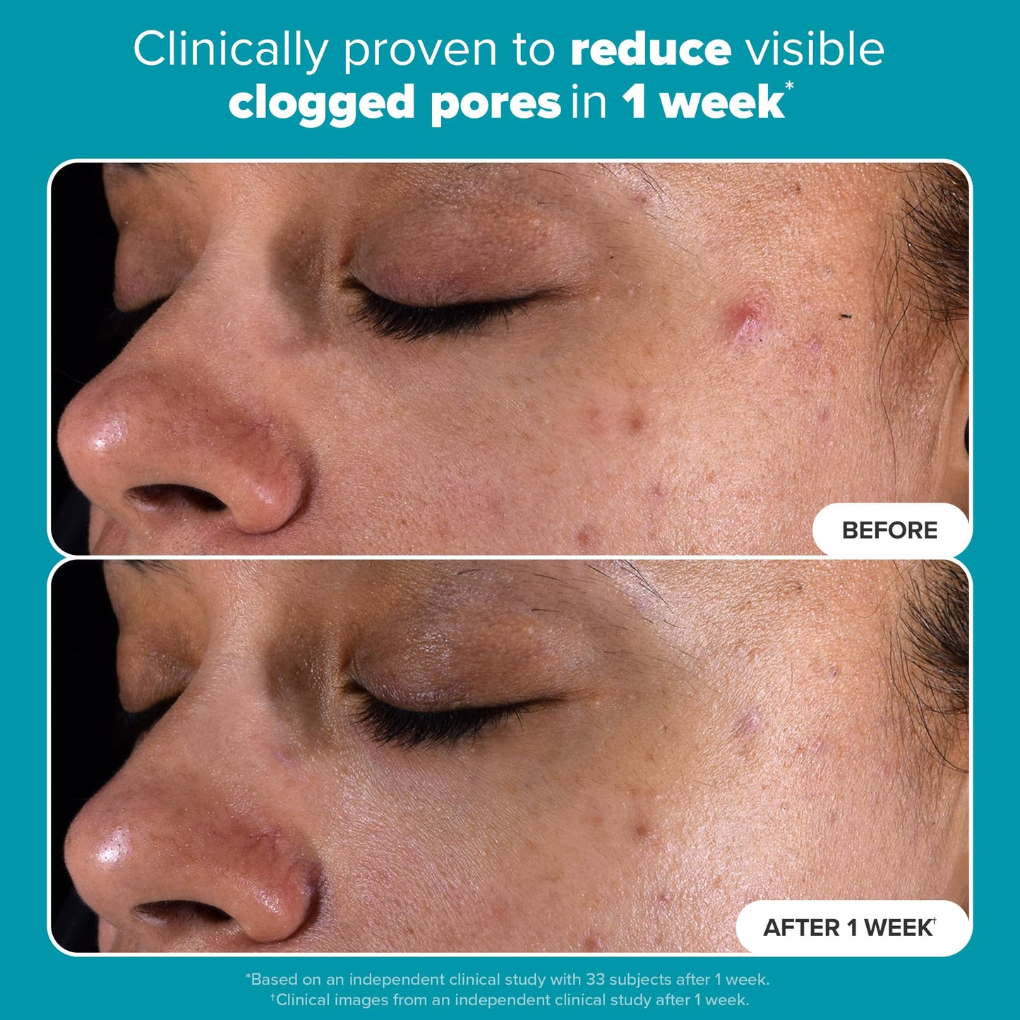 Paula's Choice SKIN PERFECTING 2% BHA Liquid Salicylic Acid Exfoliant - Blackheads & Pores, 4oz